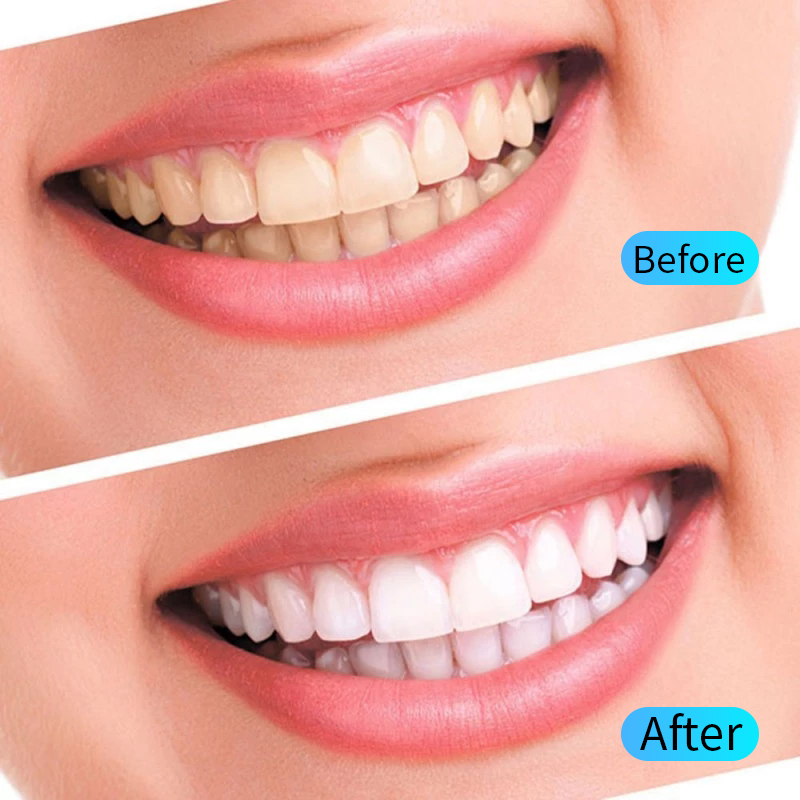 Kit Gel pemutih gigi, alat keb - Teeth Whitening Filter ulasan dan harga